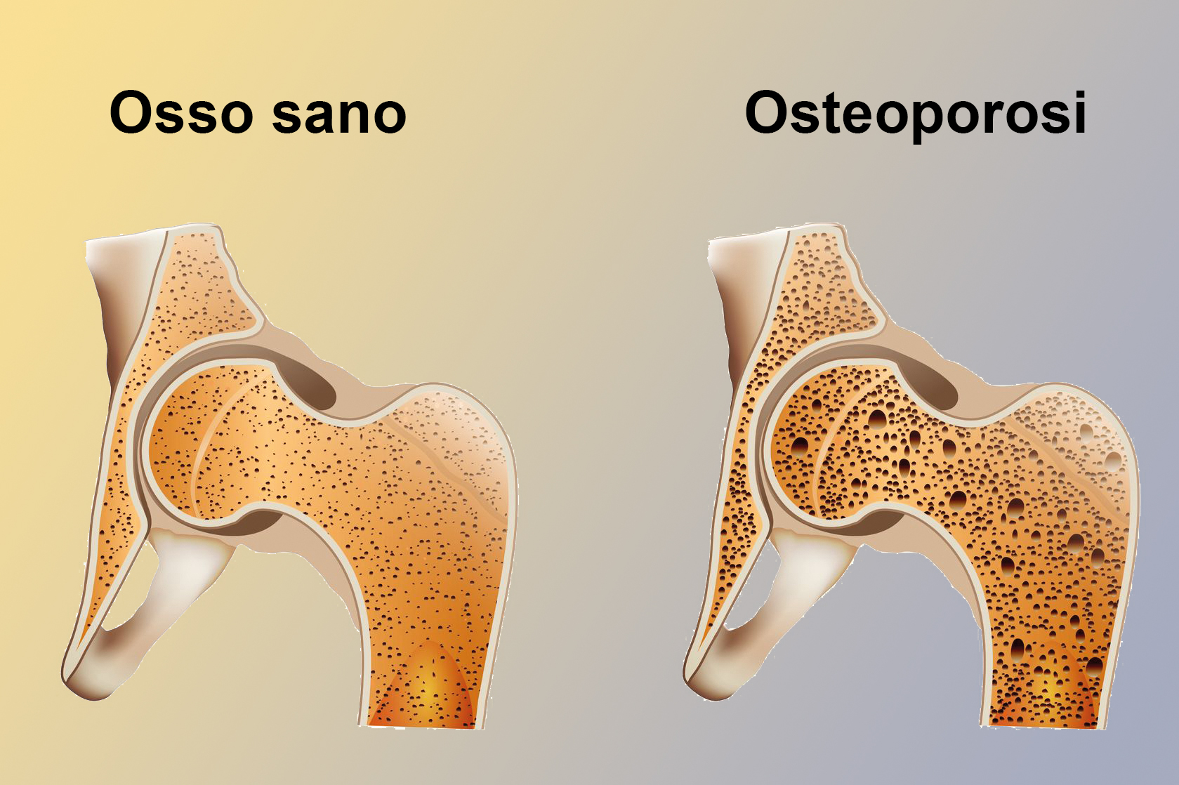 Diritti Di Chi Soffre Di Osteoporosi